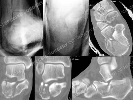 radiographs and ct scans revealing calcaneous fracture from a case example of polytrauma presented by the orthopedic trauma service at Hospital for Special Surgery.
