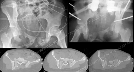 Radiographs of pelvic fracture and placement of pelvic external fixation from the orthoepdic trauma service at Hospital for Special Surgery.
