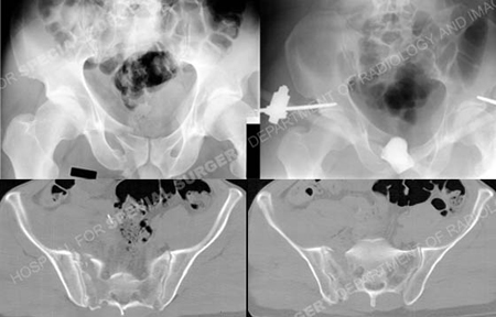 radiographs and CT scans revealing multiple fractures in sacral and pelvis from a case example of polytrauma presented by the orthopedic trauma service at Hospital for Special Surgery.