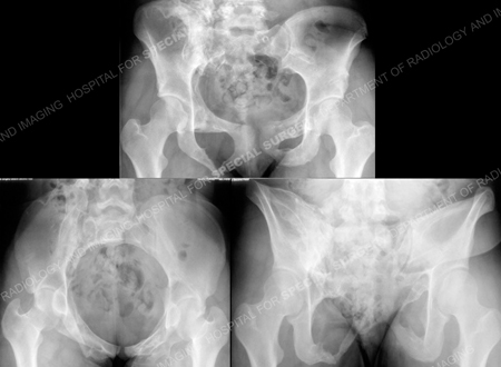 What are open book pelvic fractures?