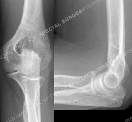 radiographs 10 months following illustrating healed olecranon fracture from a case example presented by the orthopedic trauma service at Hospital for Special Sugery.