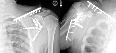 radiograph 1 year later revealing healed scapula and clavicle fractures from a case example presented by the orthopedic trauma service at Hospital for Special Surgery.