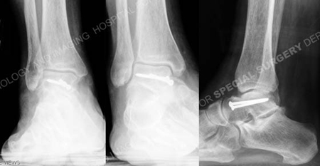 radiographs 1 year illustrating healed talus fracture from a case example presented by the orthopedic trauma service at Hospital for Special Surgery.