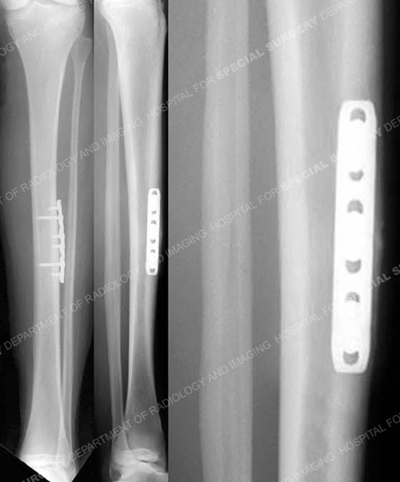 radiographs 3 months following anterior tension band plating illustrating a healing tibial stress fracture from the orthopedic trauma service at Hospital for Special Surgery.