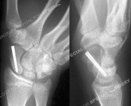 Radiographs 4 months illustrating a healed scaphoid fracture from a case example presented by the orthopedic trauma service at Hospital for Special Surgery.