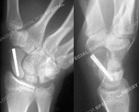 scaphoid fracture surgery