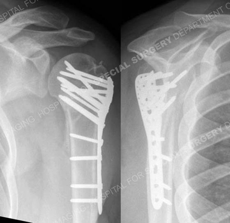 radiographs 4 months following reveal healed proximal humerus fracture from a case example of shoulder fracture from the orthopedic trauma service at Hospital for Special Surgery.