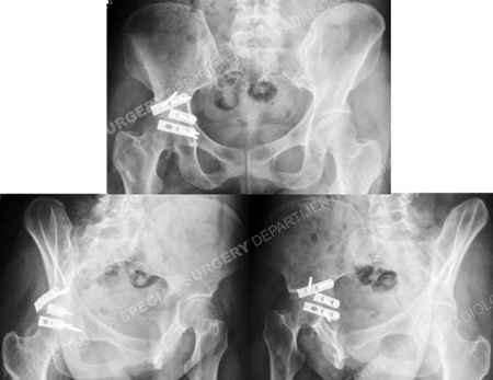 Radiographs at 5 months illustrating a healed posterior wall acetabular fracture from a case example presented by the orthopedic trauma service at Hospital for Special Surgery.