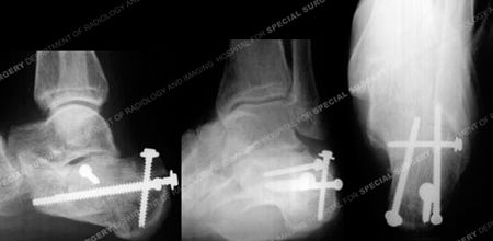 Radiograph 6 months following calcaneus fracture surgery from a case example of foot fractures from the orthopedic trauma service at Hospital for Special Surgery.