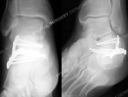 radiographs at 6 months revealing healed calcaneous fracture from a case example of Polytrauma from the orthopedic trauma service at Hospital for Special Surgery.