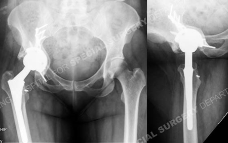 Radiographs at 6 months healed the periprosthetic acetabular fracture from a case example presented by the orthopedic trauma service at Hospital for Special Surgery.