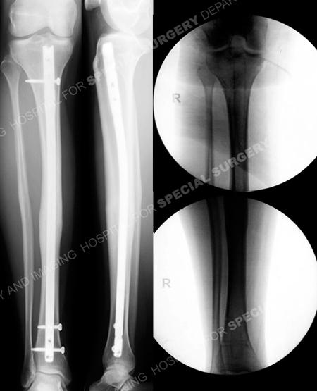 Radiographs revealing healed tibial malunion from a case example of mid-shaft tibia stress fracture from the orthopedic trauma service at Hospital for Special Surgery.