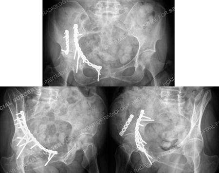 radiographs 9 years later after acetabular fracture surgery from a case example presented by the orthopedic trauma service at Hospital for Special Surgery.