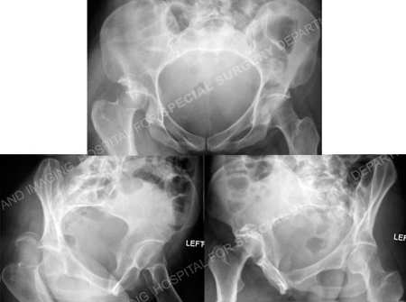 Radiographs revealing acetabular fracture from a case example presented by the orthopedic trauma service at Hospital for Special Surgery.