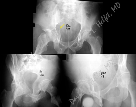 radiographs revealing an acetabular fracture from a case example presented by the orthopedic trauma service at hospital for special surgery.