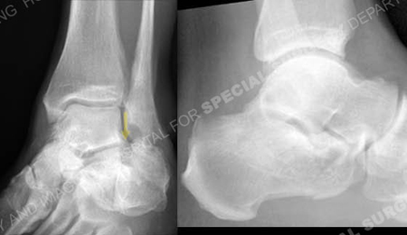 Injury radiographs revealing a calcaneus fracture from Orthopedic Trauma Service at Hospital for Special Surgery