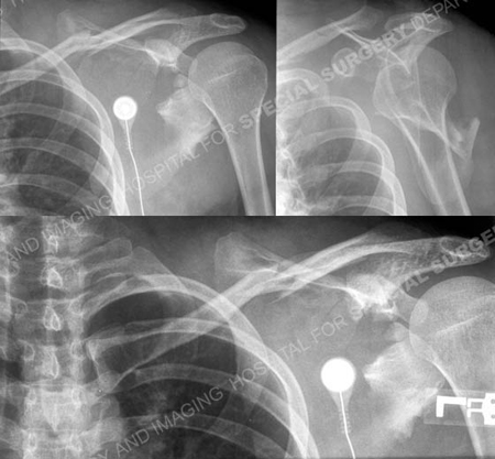 Radiographs illustrating complex scapula fracture with an associated clavicle fracture from the orthopedic trauma service at Hospital for Special Surgery.