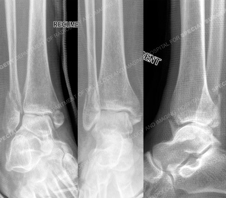 Radiographs reveals displaced bi-maleolar ankle fracture, Orthopedic Trauma Service at Hospital for Special Surgery