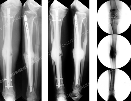 post-operative radiographs following correction of mid-shaft tibial deformity from case example presented by the orthopedic trauma service at hospital for special surgery.