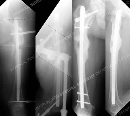 Radiographs following osteotomy from a case example on acute limb lengthening over an intramedullary nail from the orthopedic trauma service at Hospital for Special Surgery.