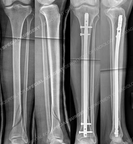 radiographs revealed tibia fracture and radiographs 9 months revealing healed tibia fracture from a case example presented by the orthopedic trauma service at Hospital for Special Surgery.