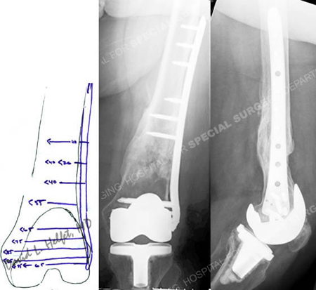 preoperative plan and radiographs 2 years following fracture surgery from a case example of periprosthetic femur fractures from the orthopedic trauma service at Hospital for Special Surgery.