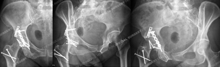 Radiographs 5 months post-operative, healed femoral head from a case example presented by the orthopedic trauma service at Hospital for Special Surgery
