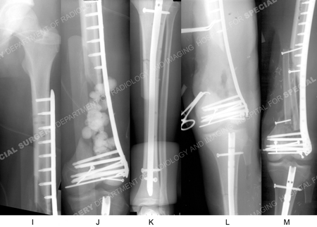 postoperative radiographs from distal femur fracture case example presented by the orthopedic trauma service at hospital for special surgery.