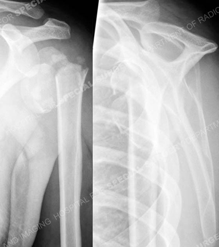 Radiographs of proximal humerus fracture and associated shoulder dislocation from a case example presented by the orthopedic trauma service at Hospital for Special Surgery.