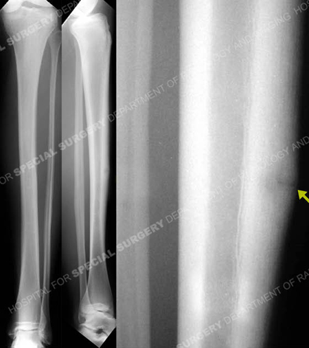 Radiographs revealing a stress fracture of the anterior tibial cortex from a case example presented by the orthopedic trauma service at Hospital for Special Surgery.