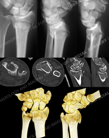 Radiographs revealing an unstable left-sided distal radius fracture and CT scan from a case example of a wrist fracture from the orthopedic trauma service at Hospital for Special Surgery.