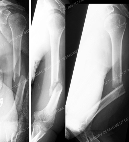 radiographs revealing mid-shaft humerus fracture from a case example presented by the orthopedic trauma service at Hospital for Special Surgery.