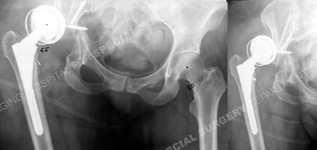 Radiographs revealing periprosthetic acetabular from a case example presented by the orthopedic trauma service at Hospital for Special Surgery.