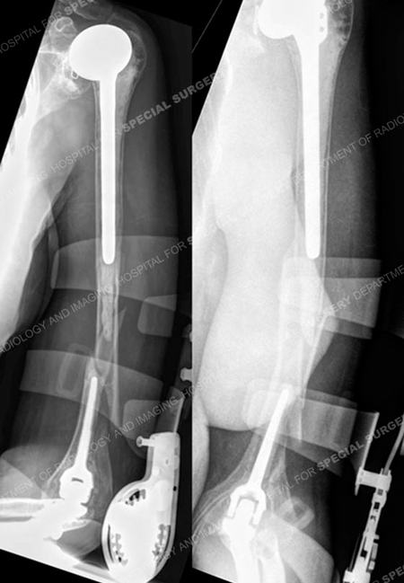 Radiographs revealing a periprosthetic humerus fracture from a case example of fractures with underlying osteoporosis from the orthopedic trauma service at Hospital for Special Surgery.