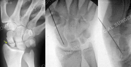 radiographs revealing a scaphoid fracture from a case example presented by the orthopedic trauma service at Hospital for Special Surgery.