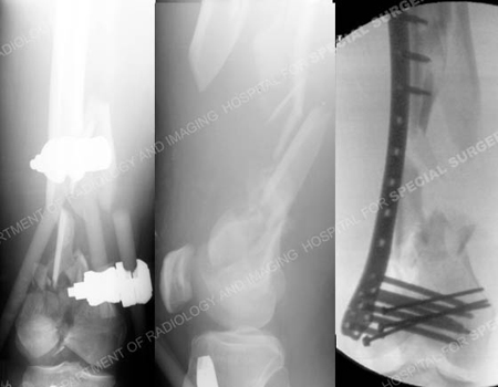Radiographs revealing supracondylar distal femur fracture from a case example of open fractures from the orthopedic trauma service at Hospital for Special Surgery.