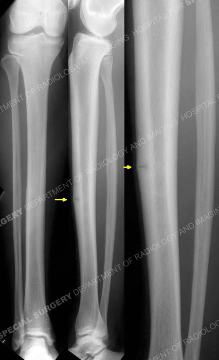 radiographs revealing stress fracture of the anterior tibial cortex from a case example presented by the orthopedic trauma service at Hospital for Special Surgery.