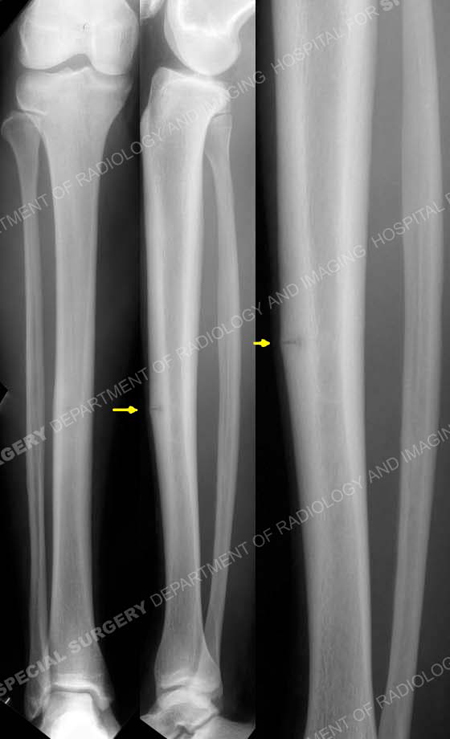 Diagram Diagram Of Tibia Stress Fracture Mydiagramonline