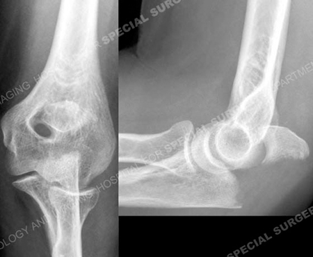 radiographs revealing an ulna olecranon fracture from a case example presented by the orthopedic trauma service at Hospital for Special Surgery.