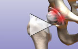 Video button thumnbail showing single operation hip revision procedure.