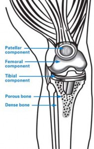 Total Knee Replacement - Post-replacement Diagram