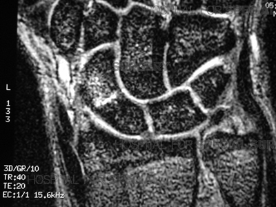 MRI of a scaphoid fracture