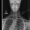 X-ray image of a patient with scoliosis