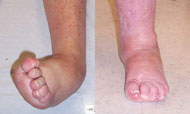 Before and After Foot Deformity Corrections from Hospital for Special Surgery