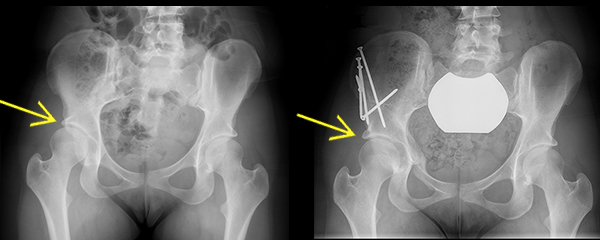 X-rays: PAO treatment of hip dysplasia, before and after.