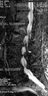MRI showing lumbar spinal stenosis.