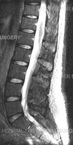 MRI showing a normal spine.