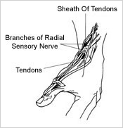 Illustration of de Quervain syndrome