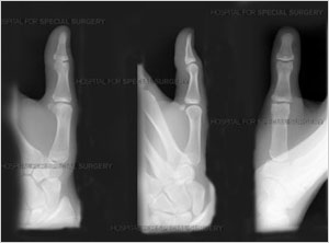 jammed finger xray