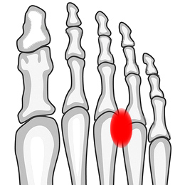 Structures of the foot, showing the common location of mortons neuroma